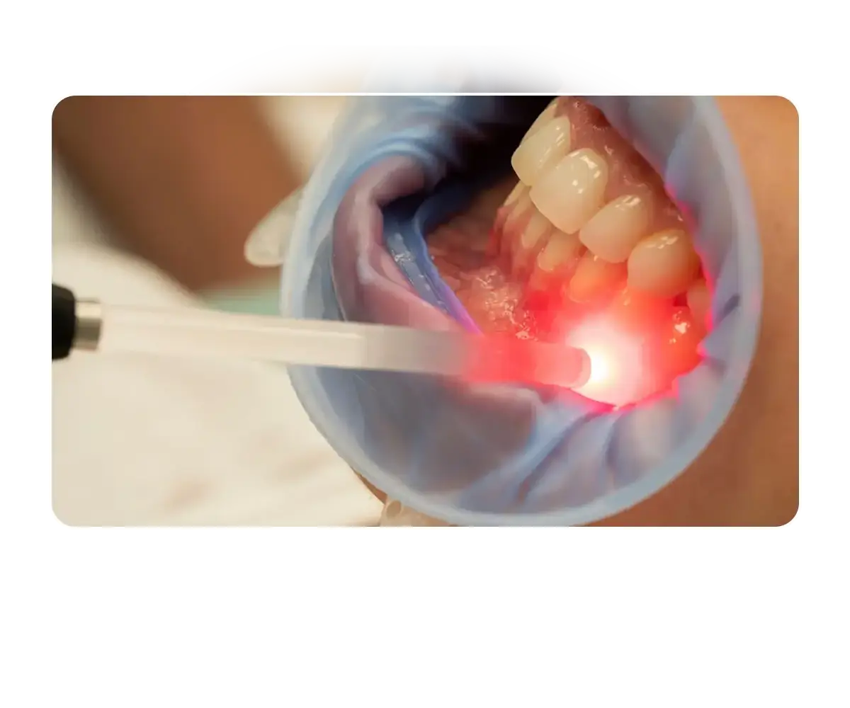 Laser Dental Treatment in Gurgaon, India