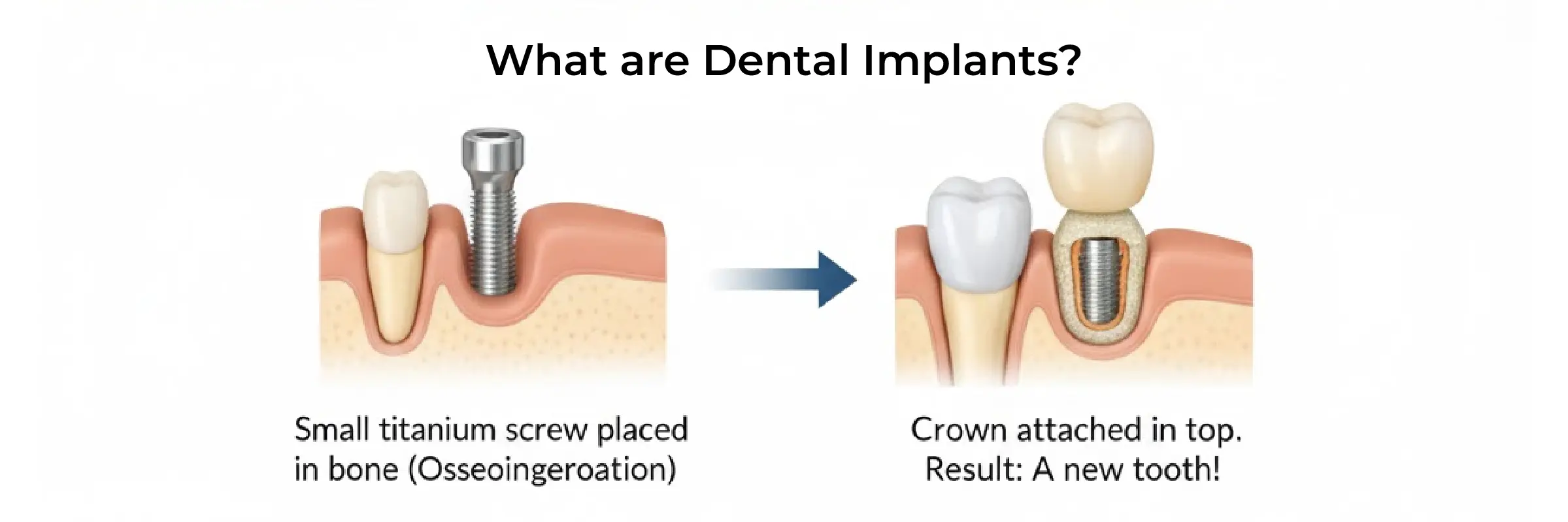 What Are Dental Implants