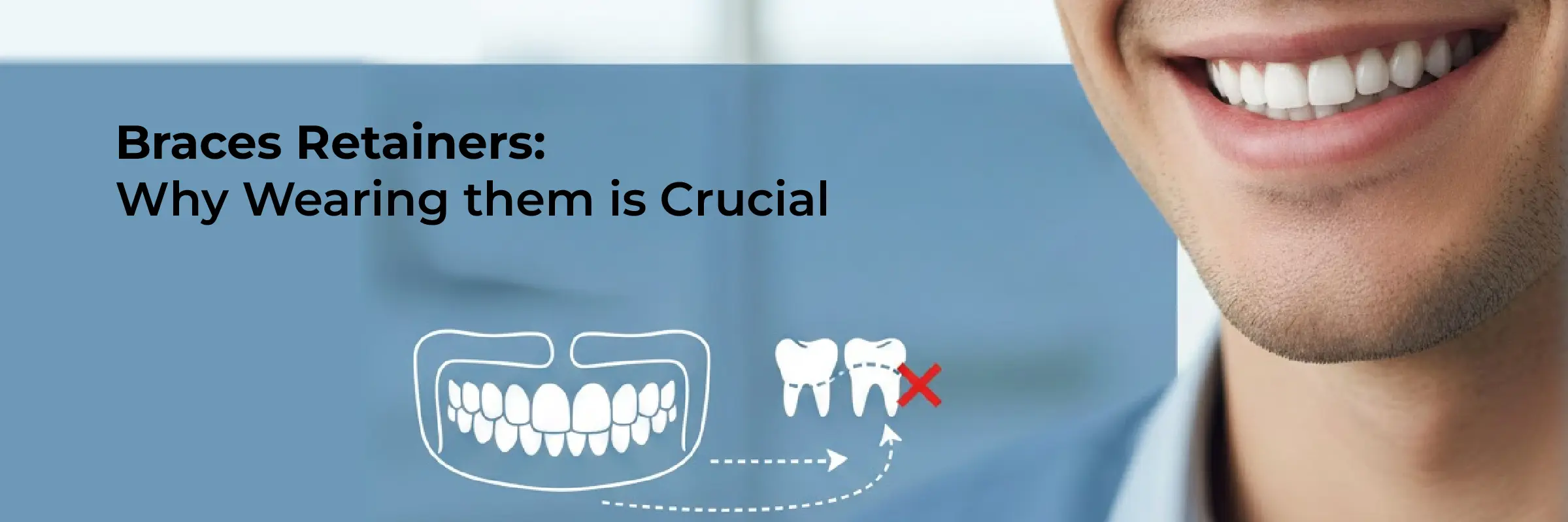 Braces Retainers: Why They Matter