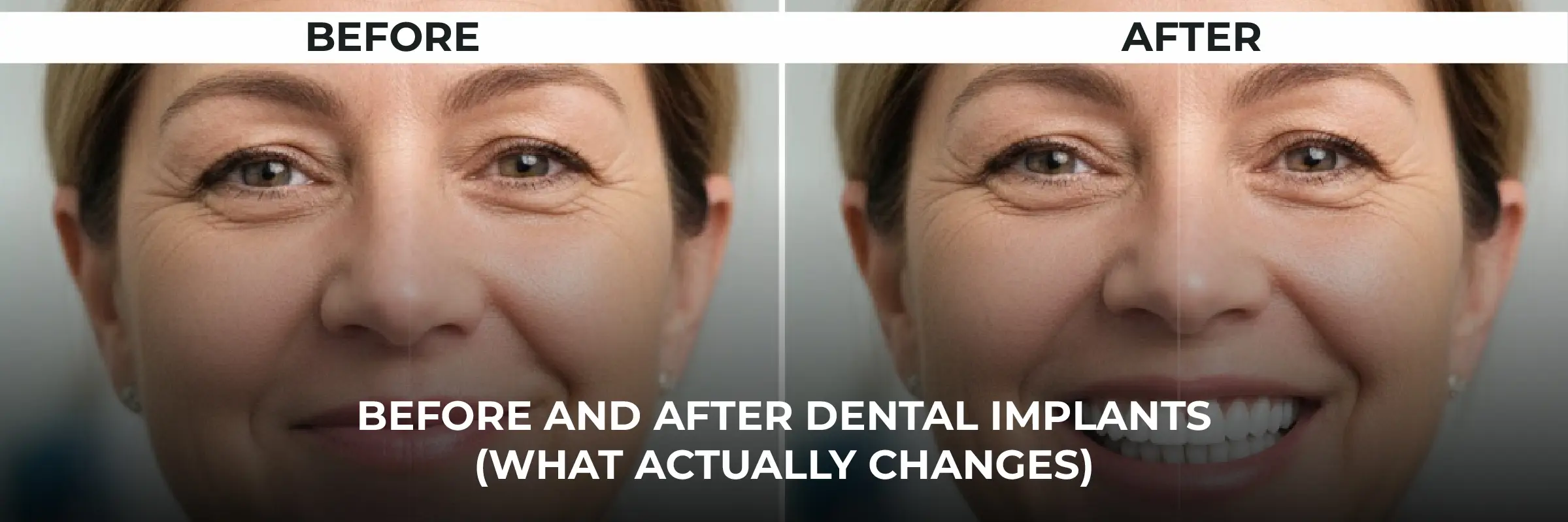Before and After Dental Implants 