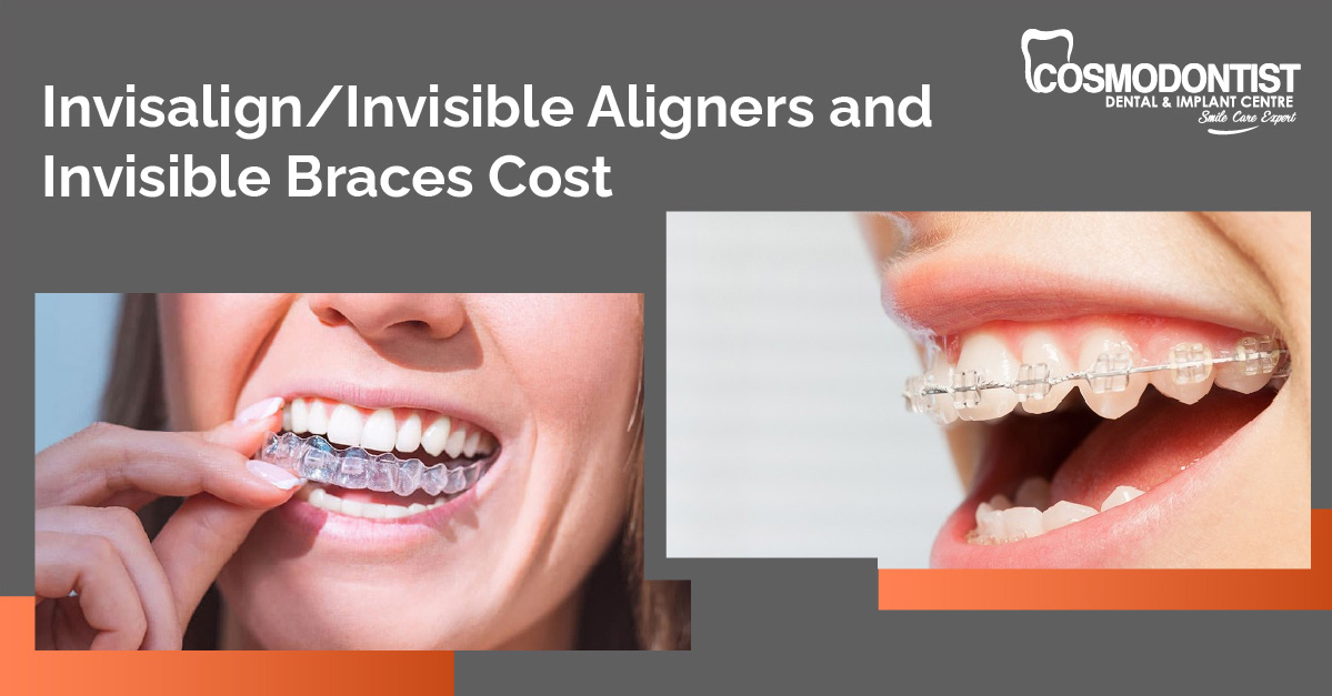 Invisalign/Invisible Aligners and Invisible Braces Cost