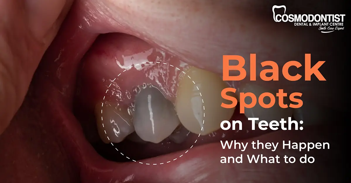Black Spots on Teeth: Why They Happen and What to Do