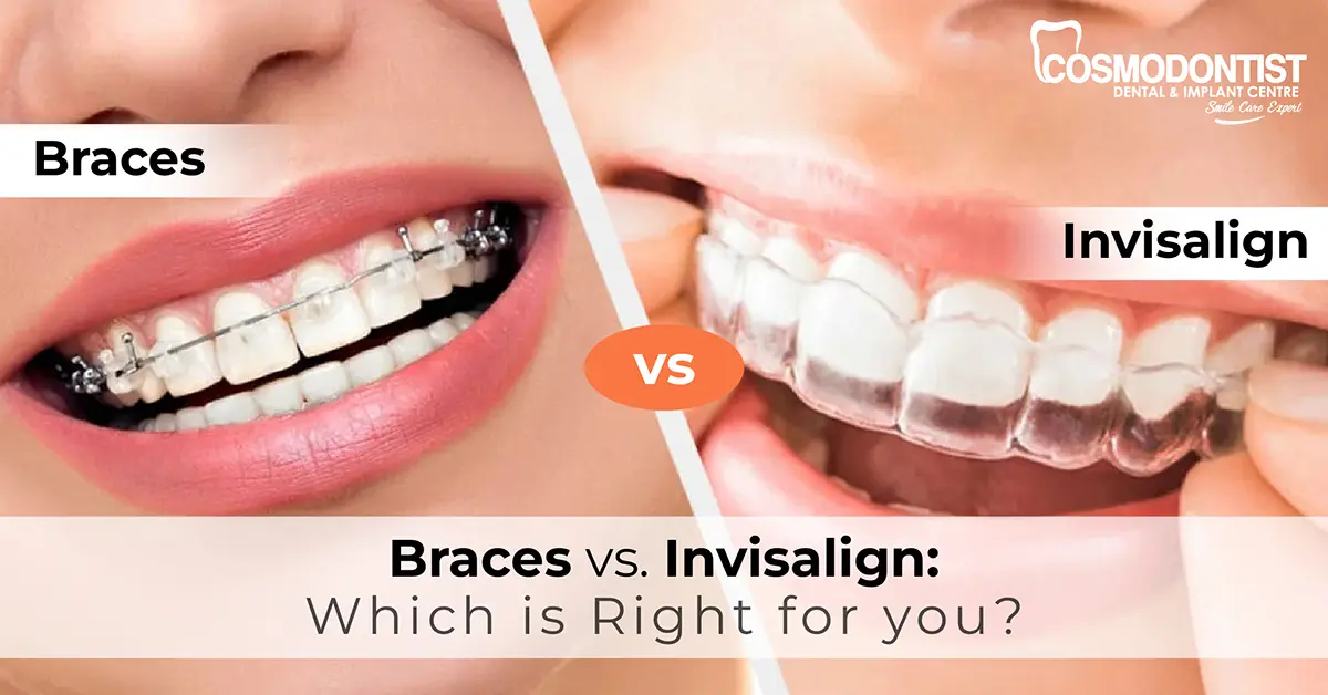 Braces vs. Invisalign: Which Is Right for You?