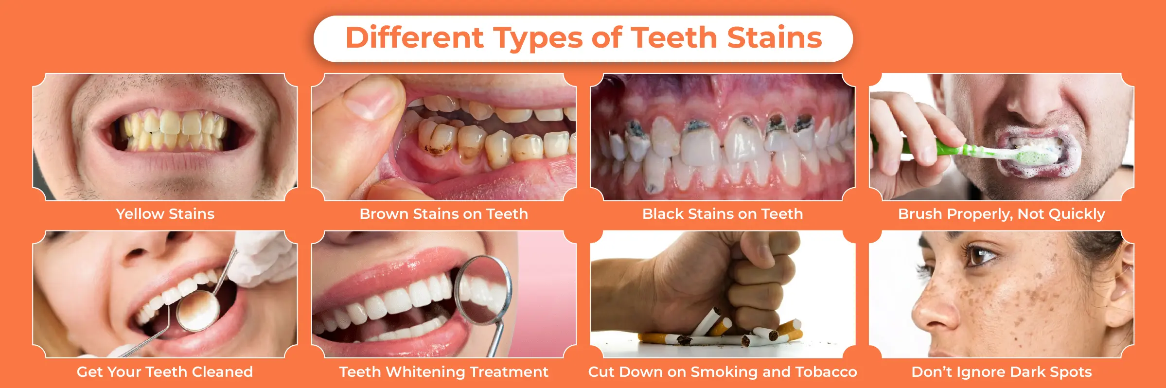 Types of teeth stains and discoloration