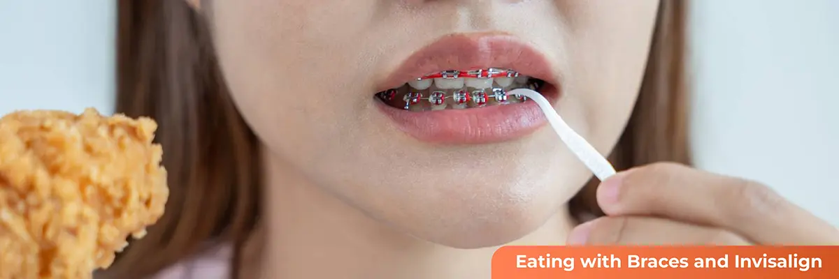 Dental Veneers