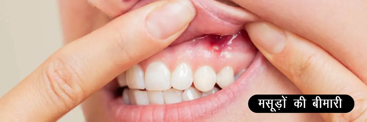(Gum Disease