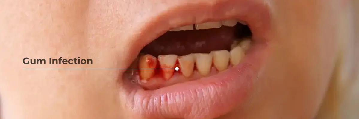 Gum Infection Causes