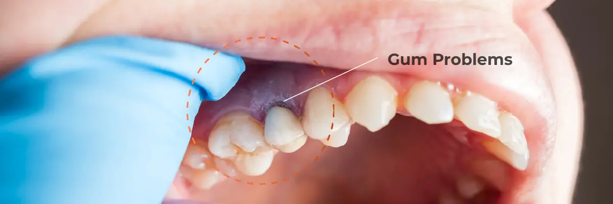 Gum Disease