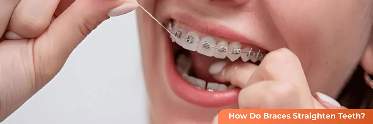 Dental Veneers
