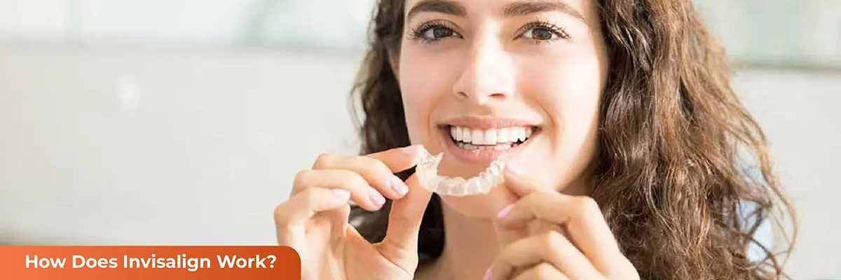 Dental Veneers