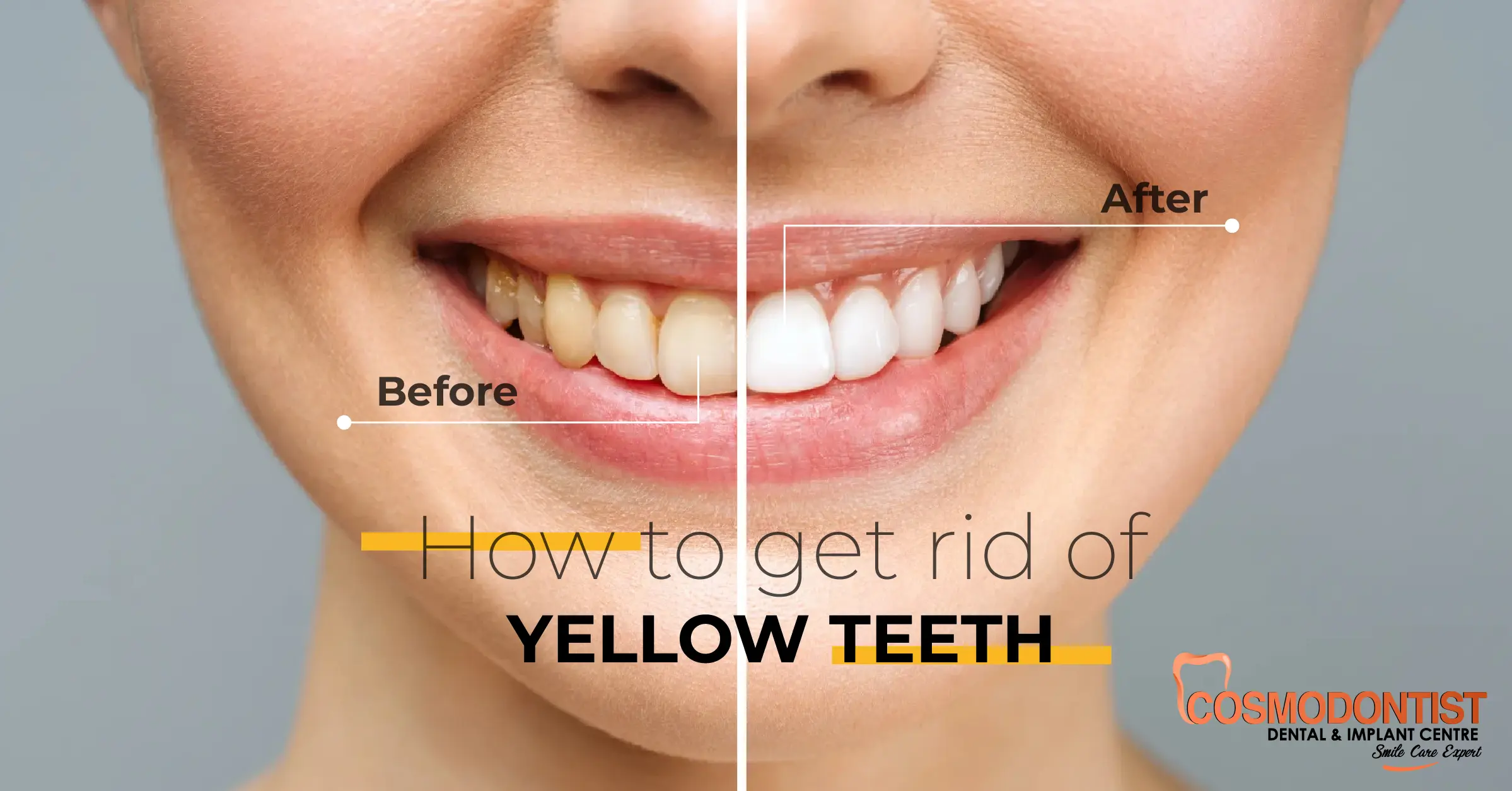 Yellow teeth whitening treatment