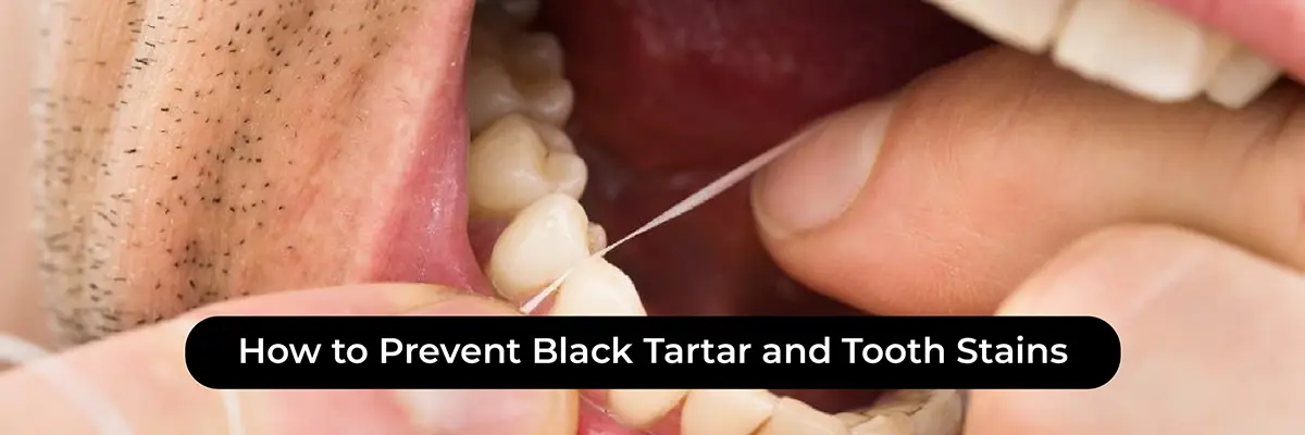 Dental Veneers