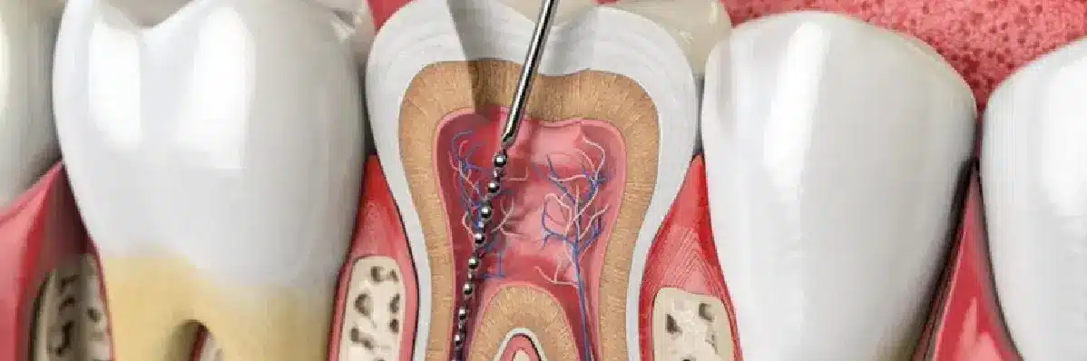 Invisalign Initial Consultation