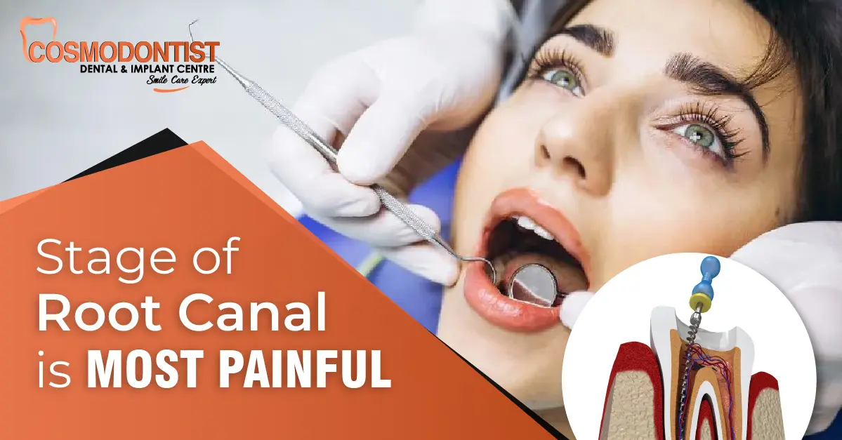 Which Stage of Root Canal Is Most Painful?