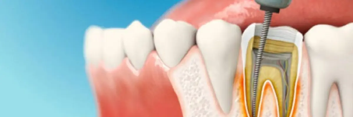 Invisalign Initial Consultation