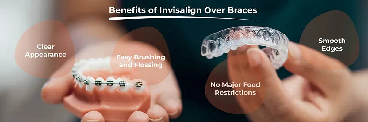 Dental Veneers