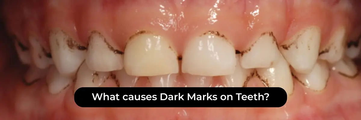 Dental Veneers