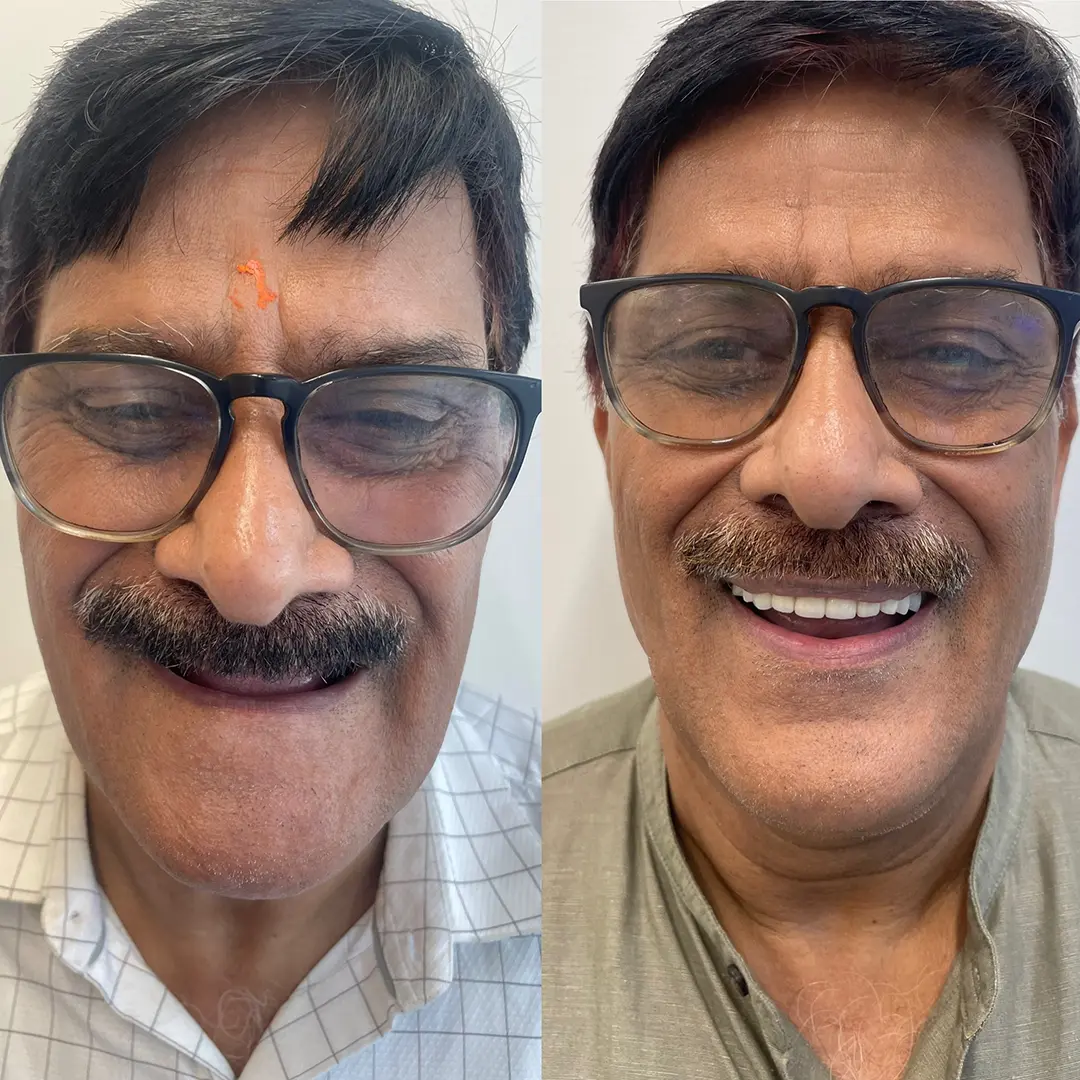 Dental Implants