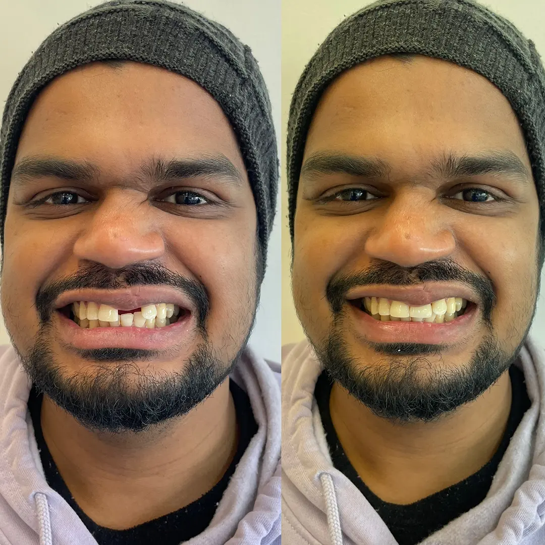Dental Implants