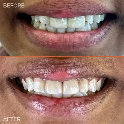 before after