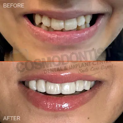 before after