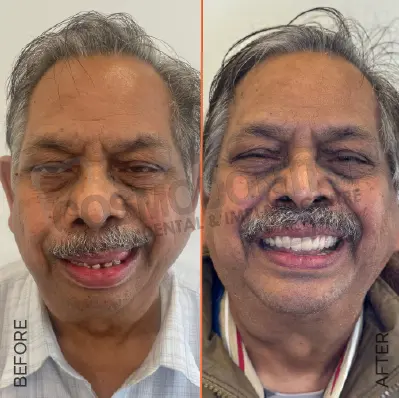 before after