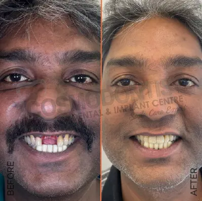 before after