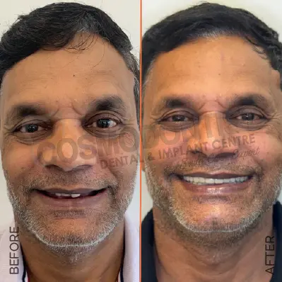 before after