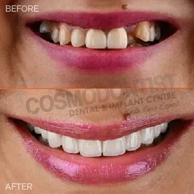 before after