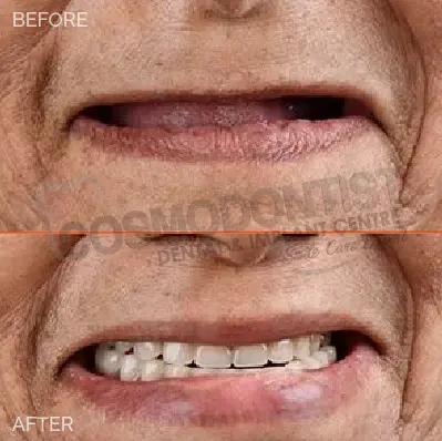 before after