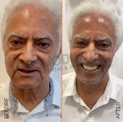 before after