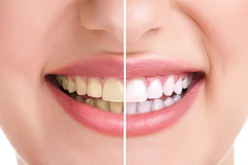 Teeth whitenings