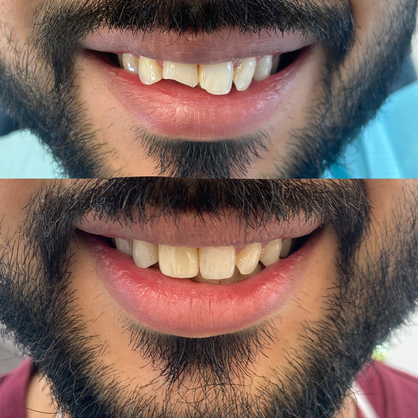 Tooth-colored dental bonding illustration