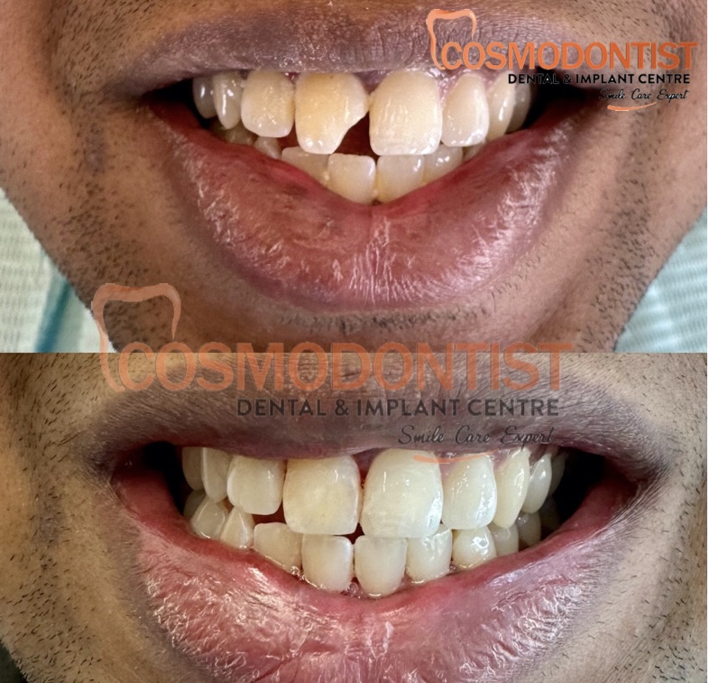 Tooth-colored dental veneer illustration