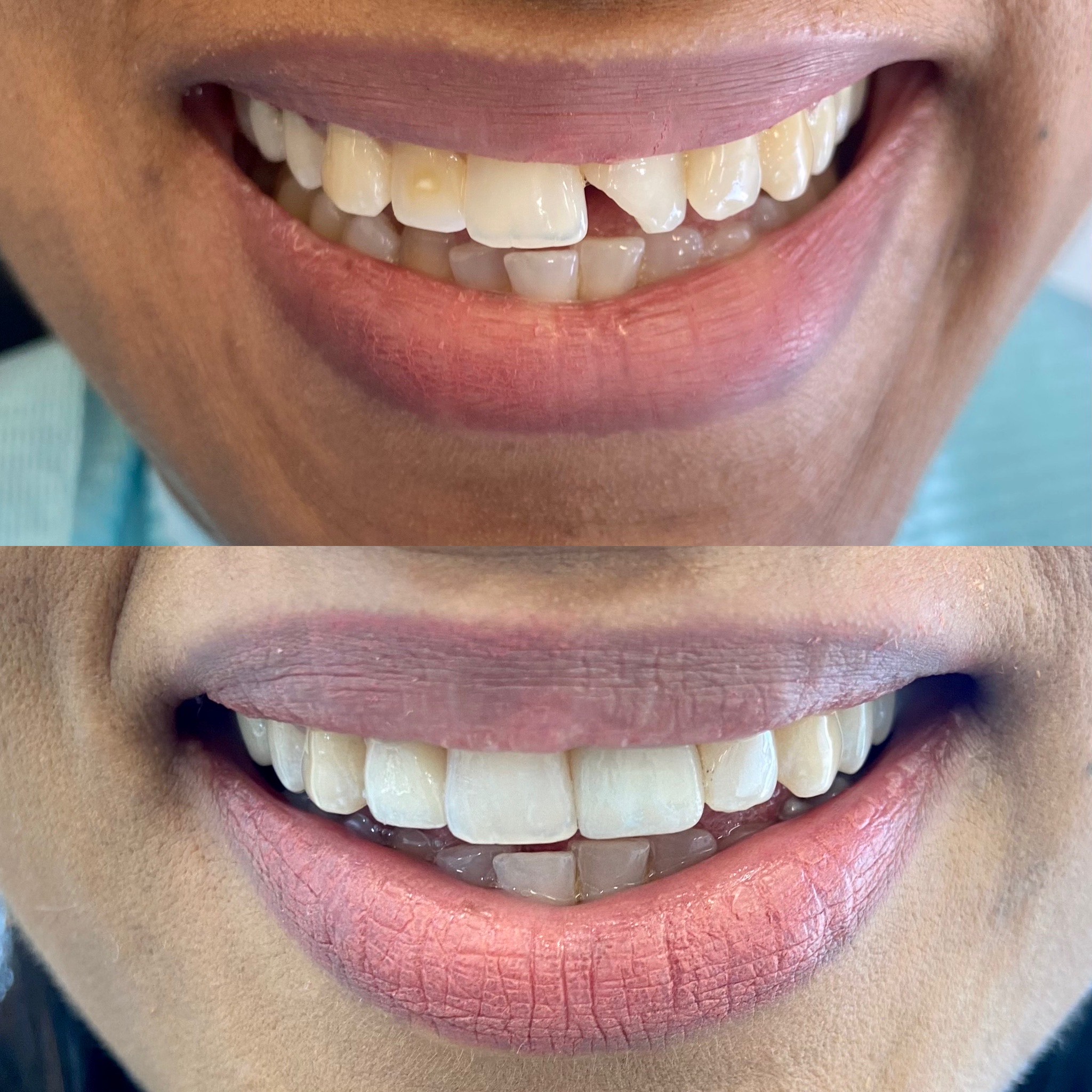 Tooth-colored dental filling illustration