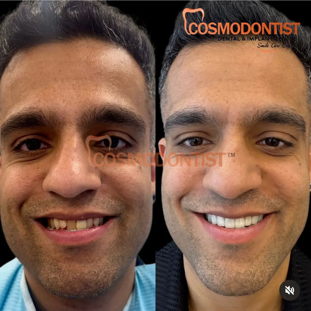 Dental Veneers Treatment in Gurgaon Before and after