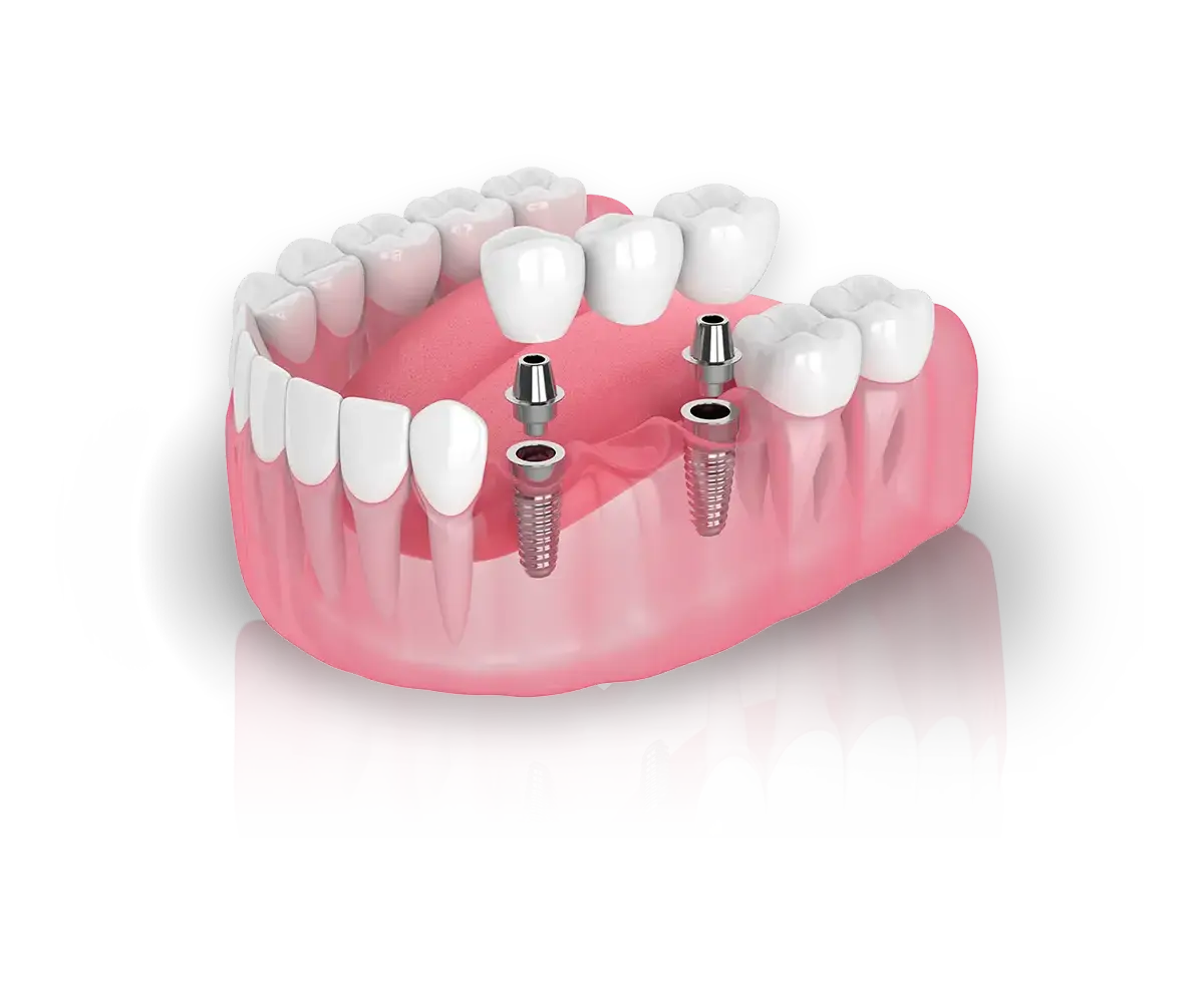 Implant-Supported Bridges