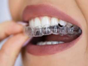 Invisalign Aligners & Braces Image