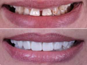 Smile Designing Treatment