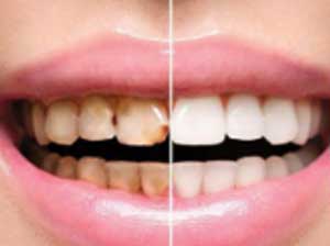 Teeth Whitening Treatment