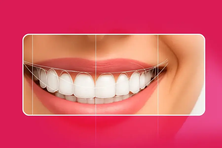 Smile designing treatment at Cosmodontist Dental Clinic