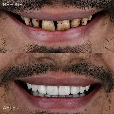 Tooth-colored dental bonding illustration