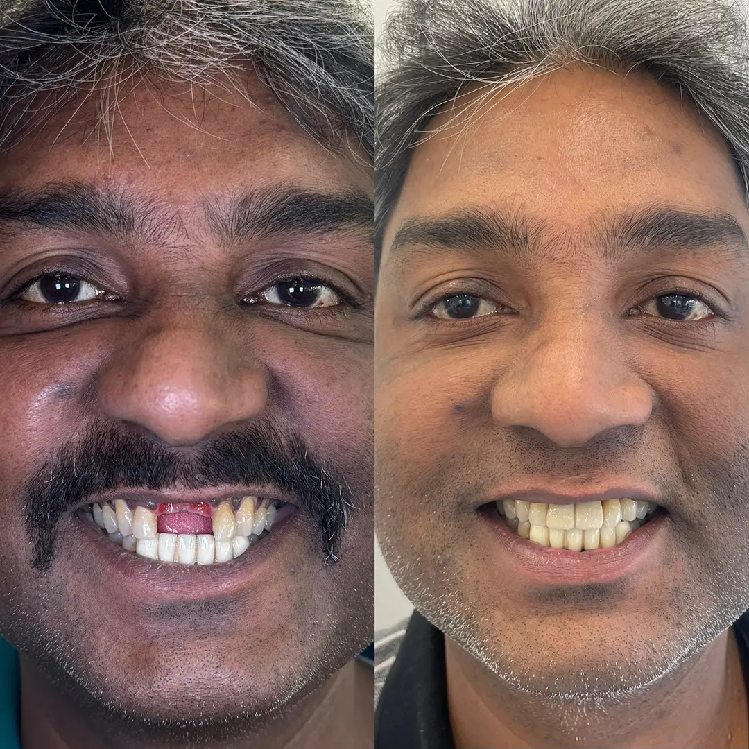 Dental Implants