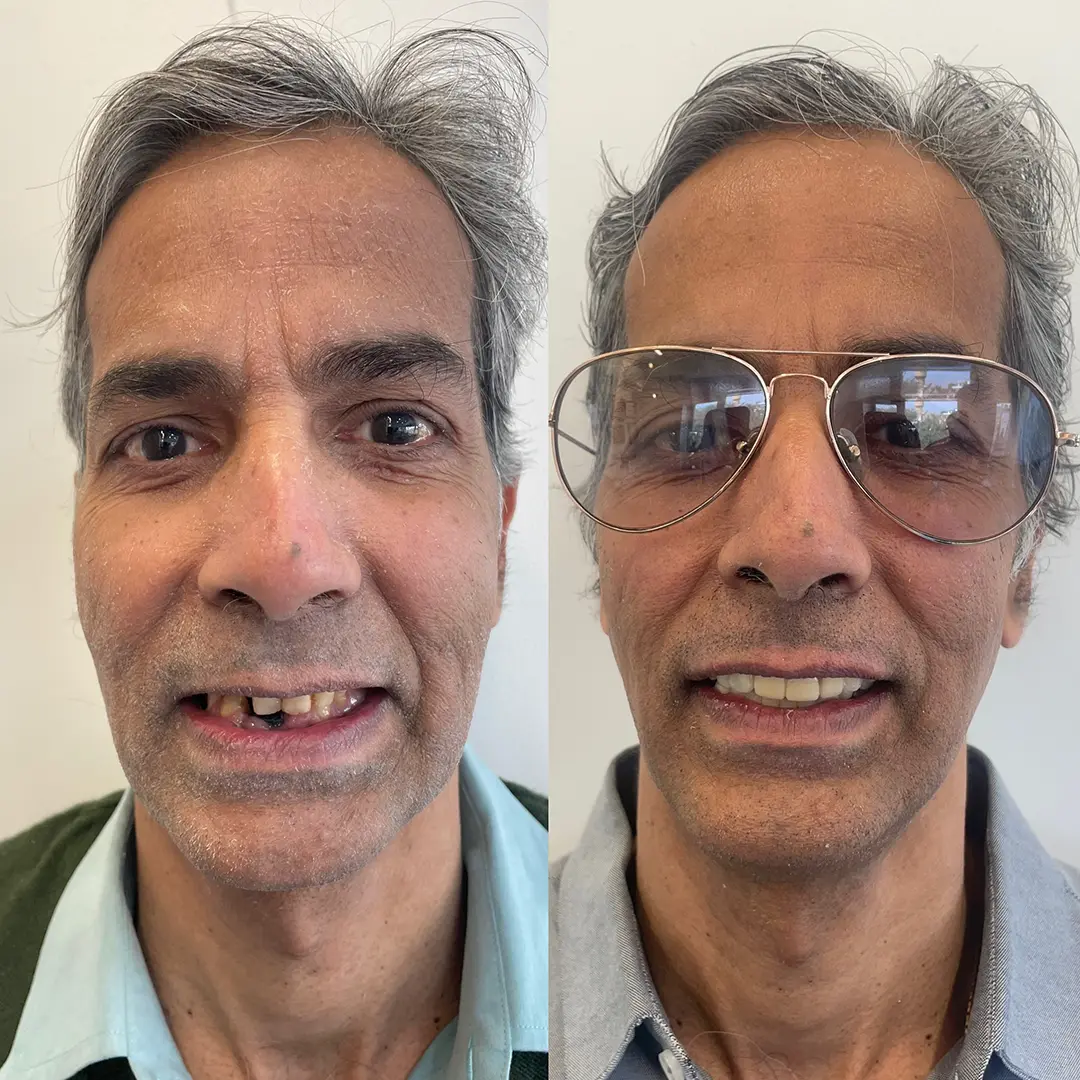 Dental Implants