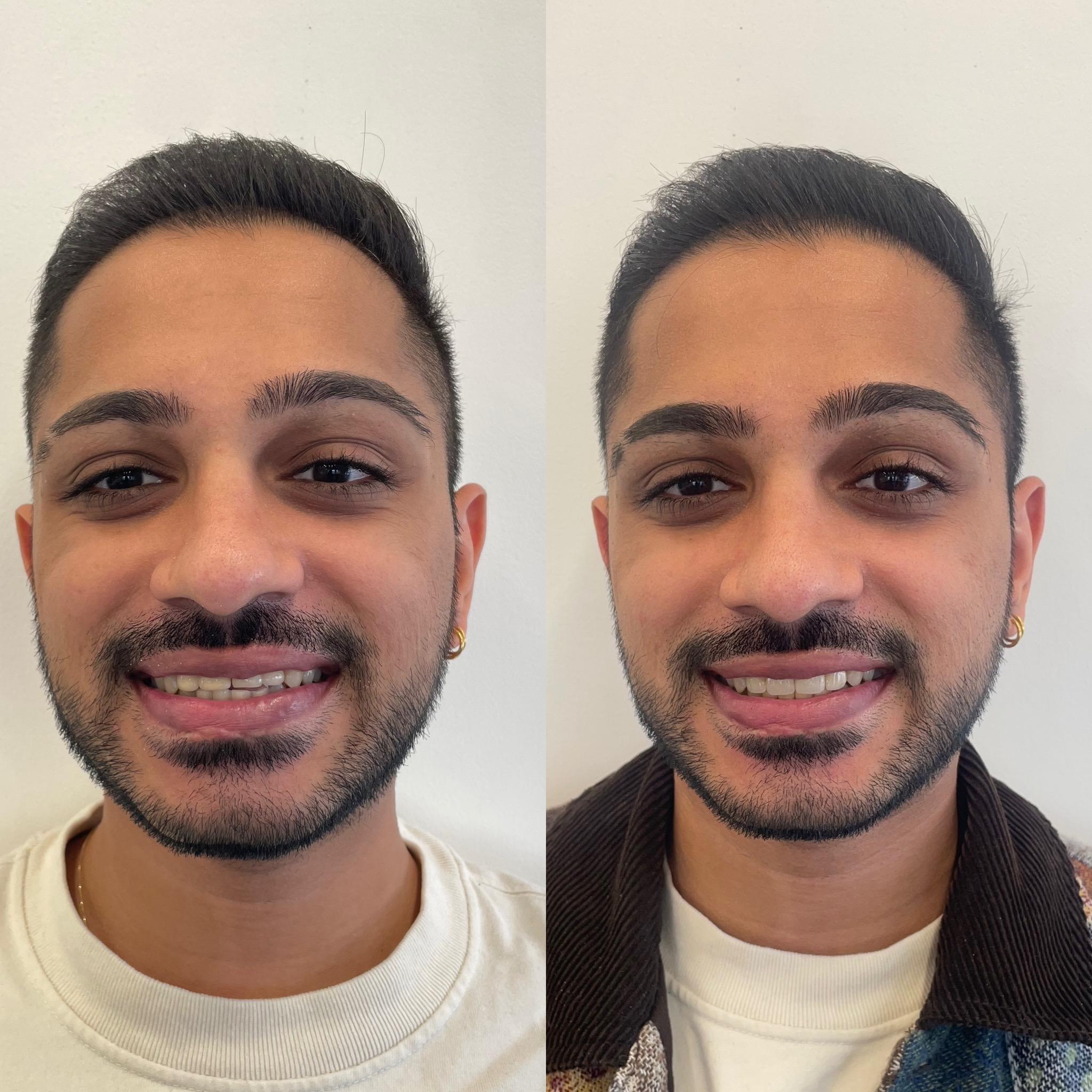 Composite Resin Veneers