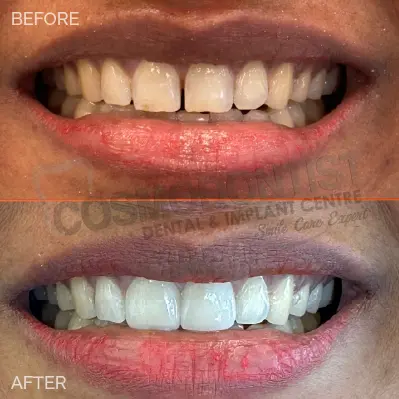 Composite Resin Veneers