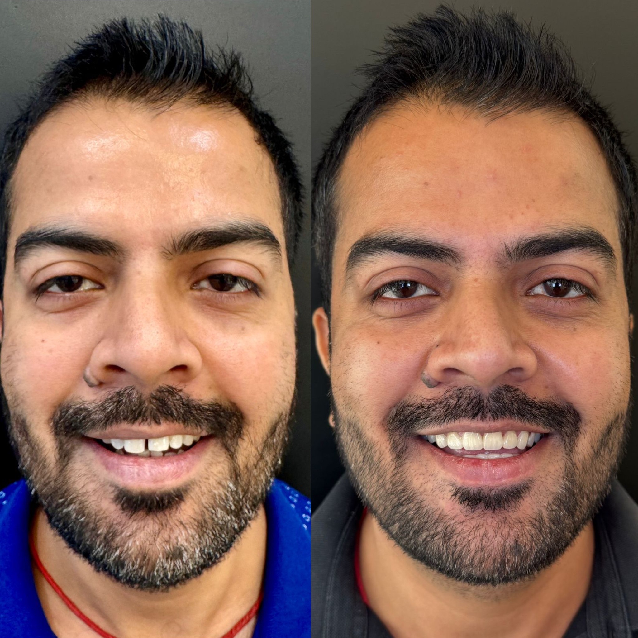 Dental Veneers Treatment in Gurgaon Before and after