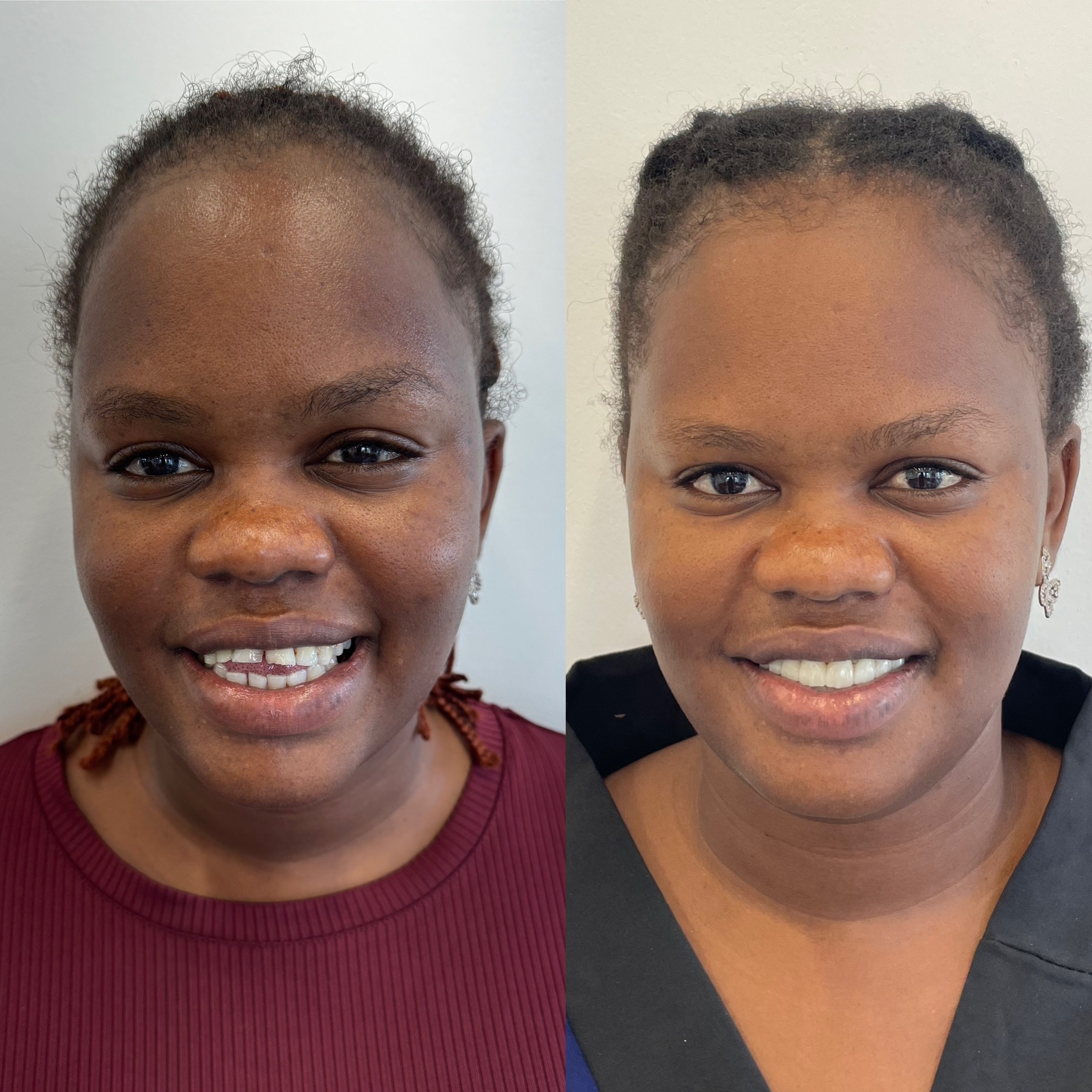 Dental Veneers Treatment in Gurgaon Before and after