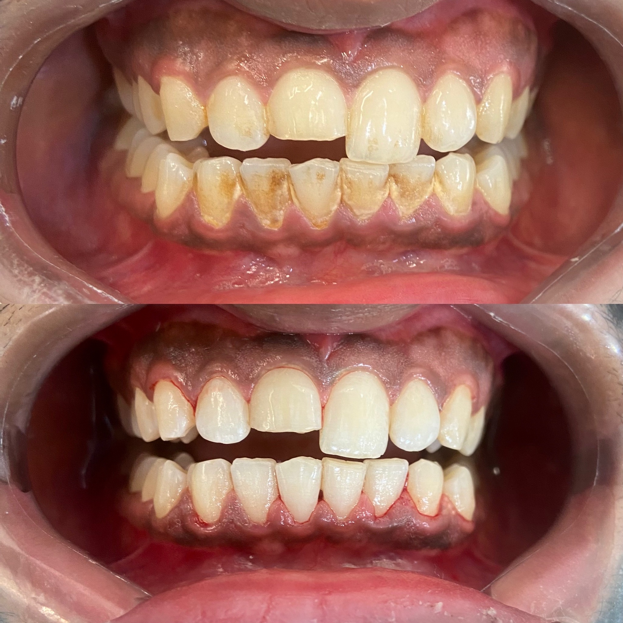 Instant Teeth Whitening Treatment