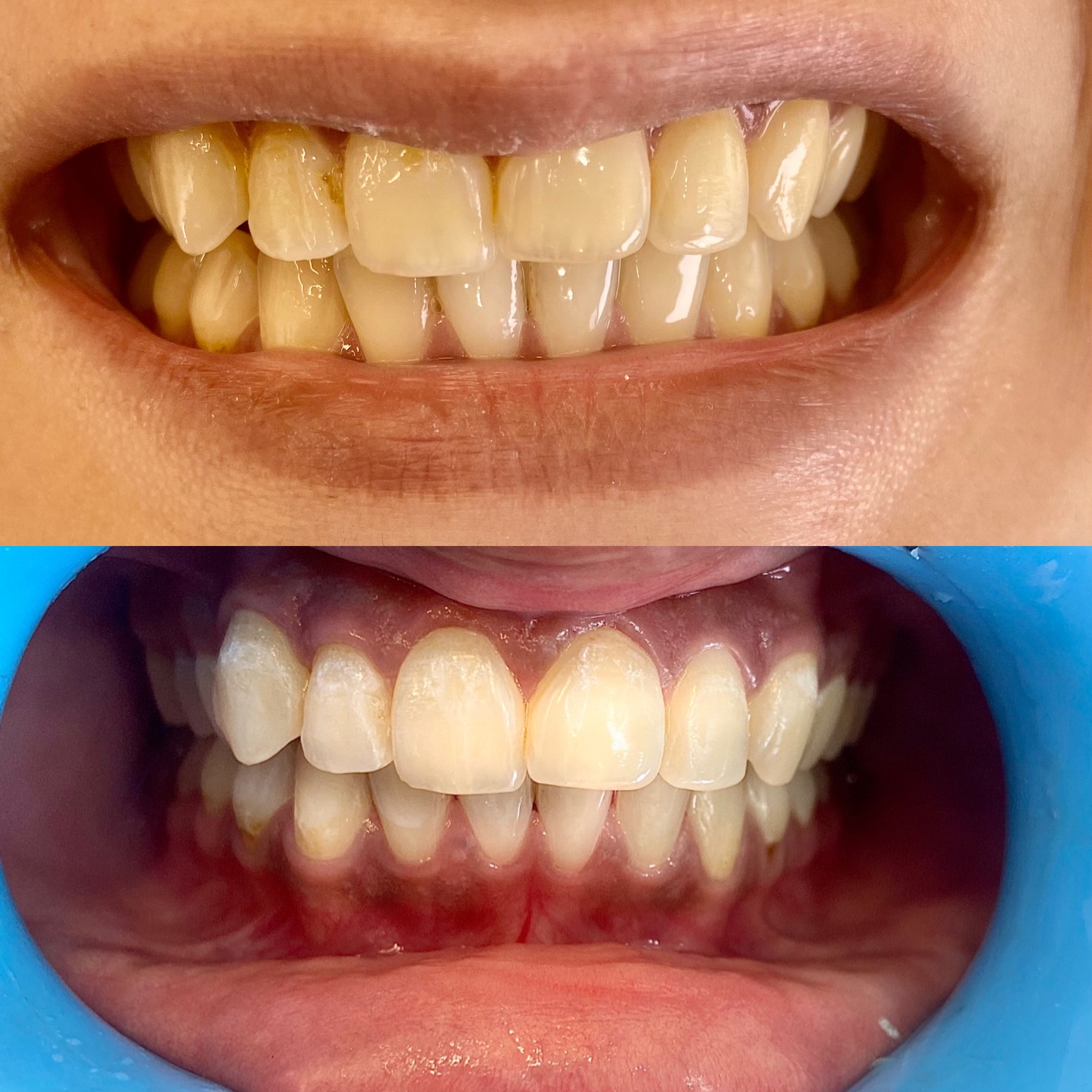 Instant Teeth Whitening Treatment